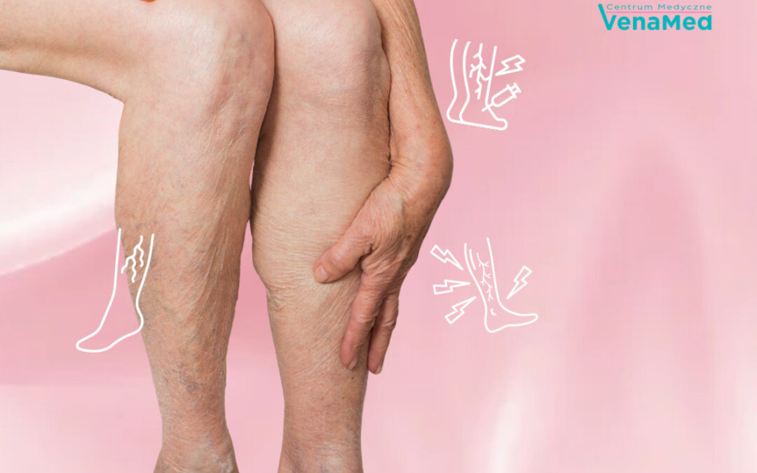 Nowoczesne leczenie żylaków w&nbsp;Warszawie – laser EVLT i&nbsp;skleroterapia