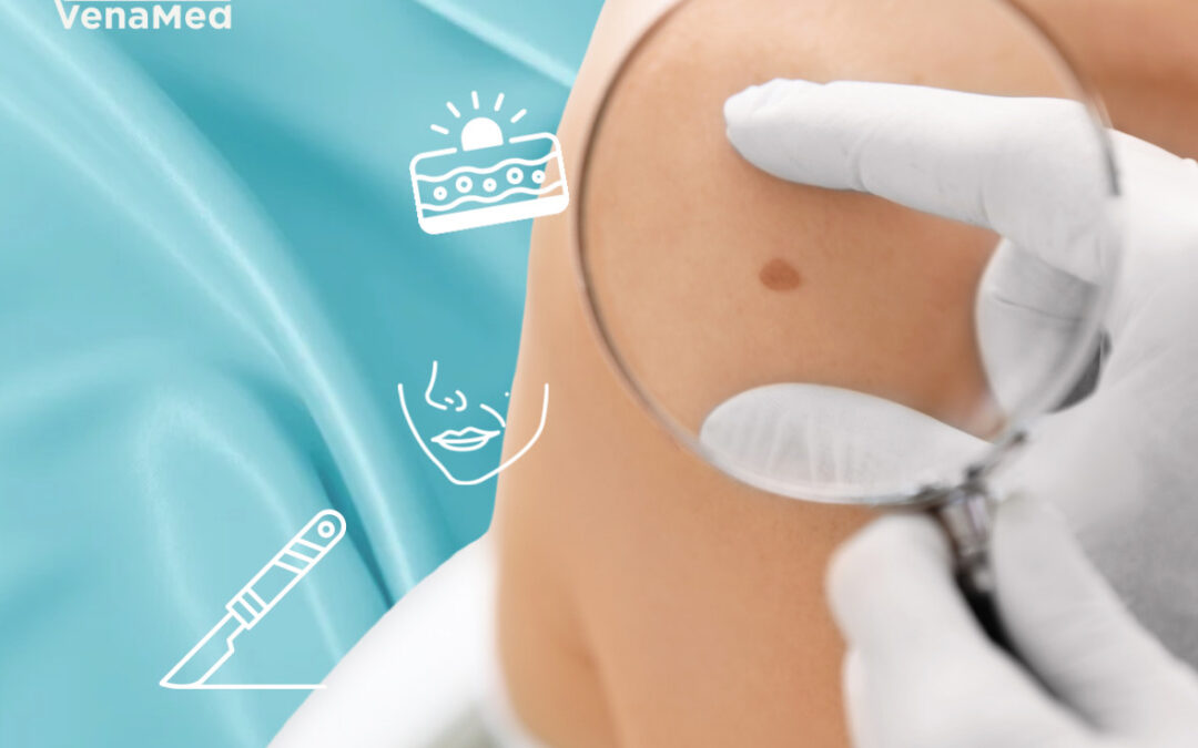 Usuwanie zmian skórnych w&nbsp;Warszawie – bezpieczne drobne zabiegi chirurgiczne w&nbsp;CM&nbsp;VenaMed