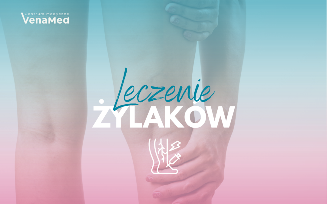 Leczenie żylaków