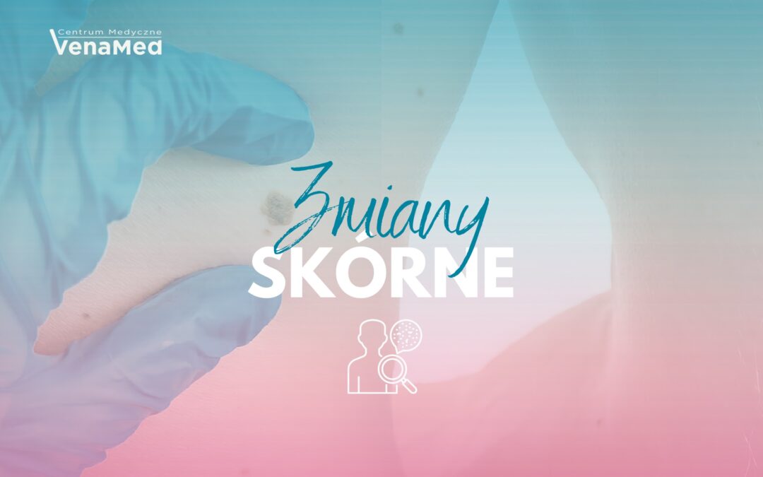 Kiedy zbadać zmiany skórne – profilaktyka, która&nbsp;ratuje zdrowie