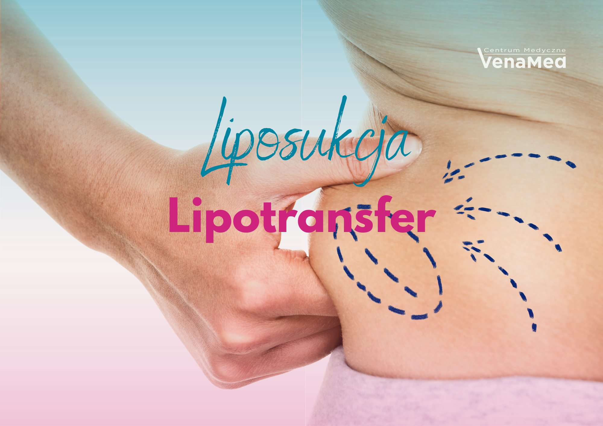 Liposukcja i&nbsp;lipotransfer w&nbsp;Warszawie – modelowanie sylwetki